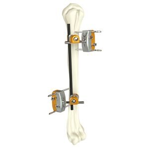 Humeral Shaft External Fixator